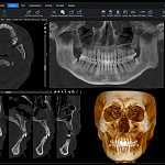 Дентальный 3D томограф Planmeca ProMax 3D Mid  (20x17 см)