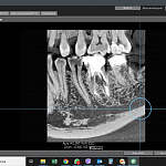 Томограф дентальный OP 3D (11*9 см) с цефалостатом
