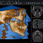Дентальный 3D томограф Planmeca ProMax 3D Mid  (20x17 см)